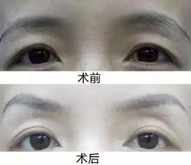 提眉术视频,轻松掌握眼部年轻化技巧