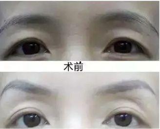 提眉术视频,轻松掌握眼部年轻化技巧